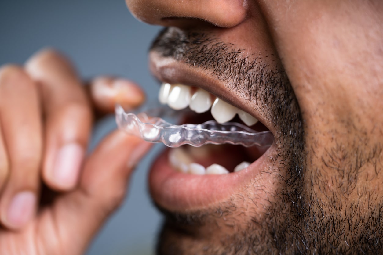 InvisAlign Ypsilanti