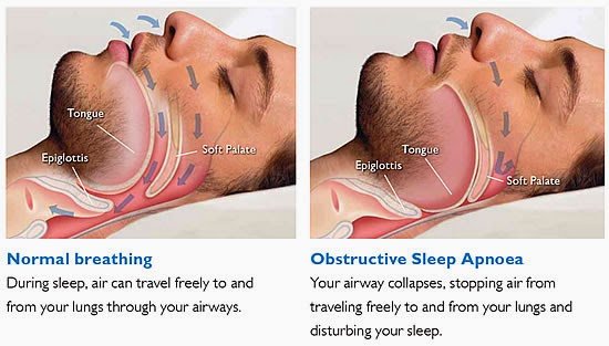 Sleep Apnea